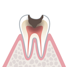 虫歯段階：C3